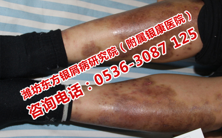 不严重的牛皮癣为何治不可以