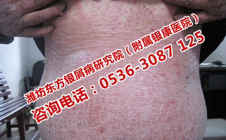 肚子上的小点点是银屑病吗