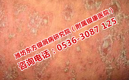 牛皮癣患者上当受骗的危害