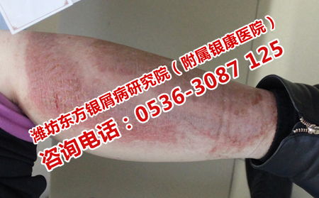 银屑病患者日常生活中要注意什么