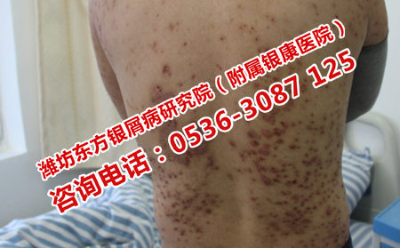 牛皮癣日常要怎么护理