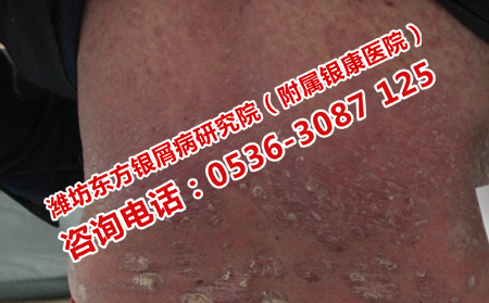 银屑病怎么止痒啊