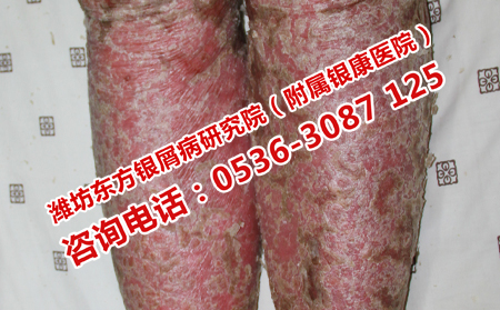 我这么年轻就得了银屑病怎么办