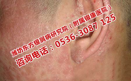 牛皮癣可以不利索的原因