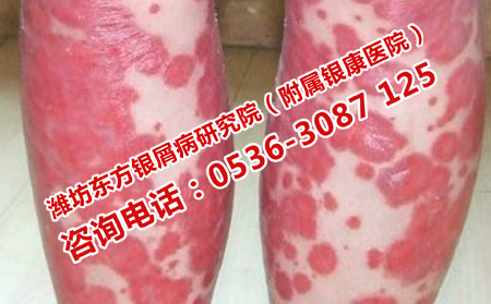 秋季银屑病穿衣饮食很重要