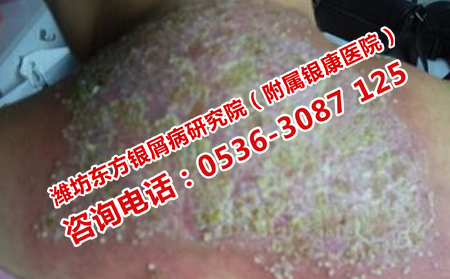 银屑病发病表现是什么样子