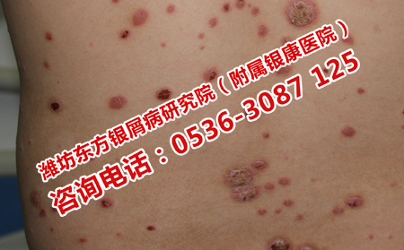 教你如何解决银屑病瘙痒