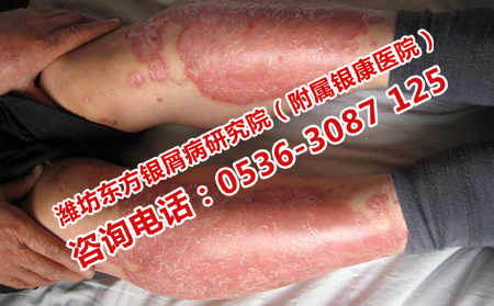 有效预防银屑病的办法