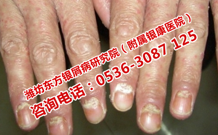 寻常型牛皮癣如何治疗