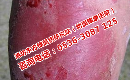 青年银屑病复发原因