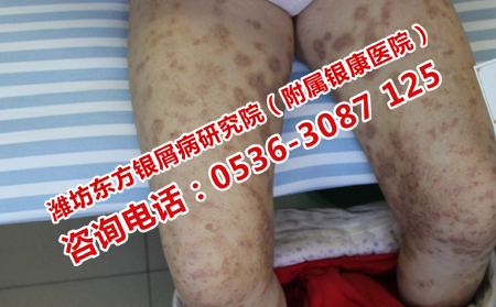 银屑病如何护理