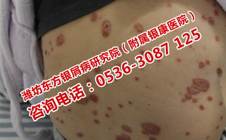 银屑病治疗期间的护理
