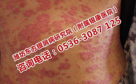 为什么感冒会造成银屑病复发