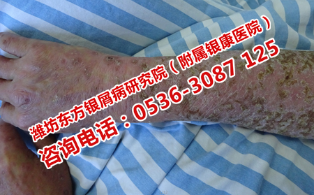 牛皮癣恢复之后复发的原因