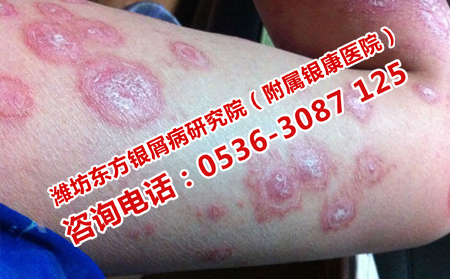 胳膊银屑病加重了如何治疗