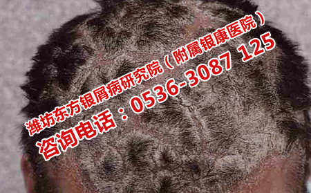 头部银屑病的护理
