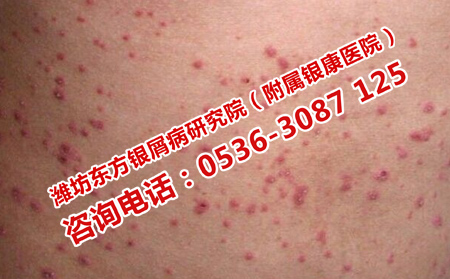 预防寻常性银屑病加重