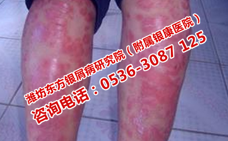 治疗中银屑病加重的原因