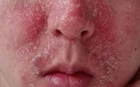 银屑病护理方法