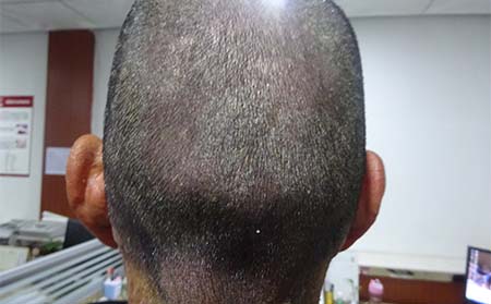 头部银屑病症状,头部银屑病症状
