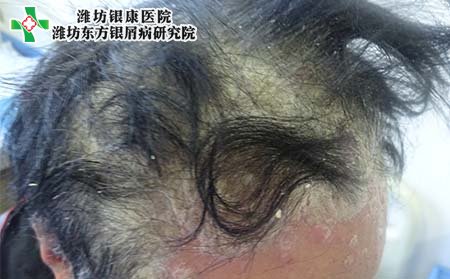 儿童头部牛皮癣,小孩头上牛皮癣怎么办